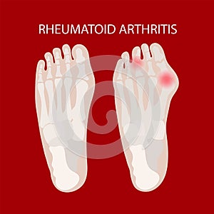 RHEUMATOID LEG Artritis Medicine Education Scheme Vector photo