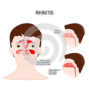 Rhinitis coryza. healthy sinuses and sinuses with inflammation