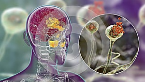 Rhinocerebral mucormycosis, a brain lesion and sinusitis caused by fungi Mucor