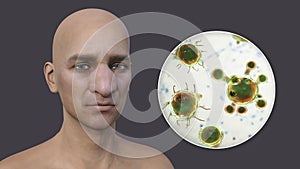 Rhinofacial conidiobolomycosis in a man and Conidiobolus coronatus fungi, 3D illustration. Tropical fungus, causes photo