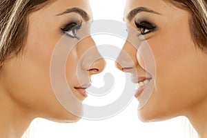 Rhinoplasty