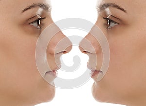 Rhinoplasty