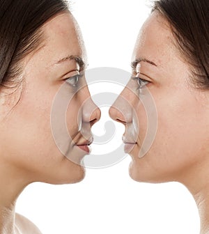 Rhinoplasty