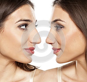 Before and after rhinoplasty photo