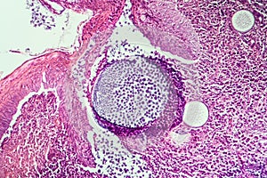 Rhinosporidium parasite diseased tissue photo