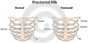 Rib Cage with a Fracture