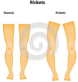 Rickets
