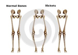 Rickets is a metabolic disease characterized by deformities of the bones. The most common symptoms are bowed legs