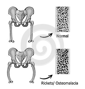 Rickets-osteomalacia