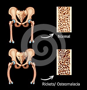 Rickets-osteomalacia