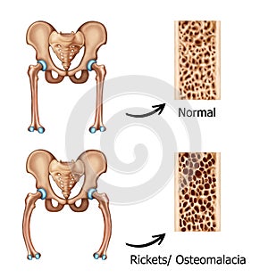 Rickets-osteomalacia