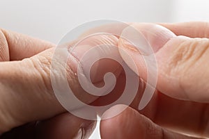 Ridged fingernails with vertical and horizontal ridges. Nails problems