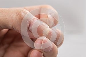 Ridged fingernails with vertical and horizontal ridges. Nails problems