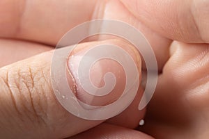 Ridged fingernails with vertical and horizontal ridges. Nails problems