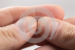 Ridged fingernails with vertical and horizontal ridges. Nails problems