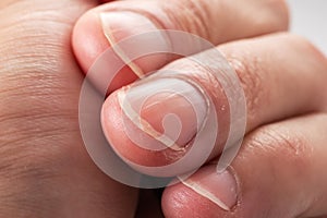 Ridged fingernails with vertical ridges.Nails problems