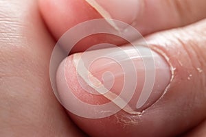 Ridged fingernails with vertical ridges.Nails problems