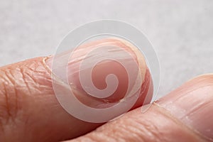 Ridged fingernails with vertical ridges.Nails problems