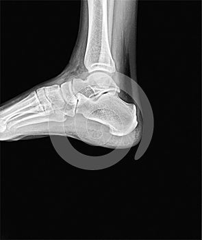 Right ankle x-ray. Side scan