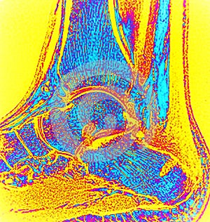 Right ankle after surgery haglund deformity mri photo