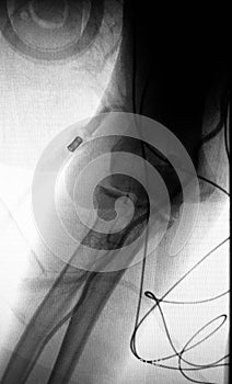 Right arm artery catheterization angiogramm ct