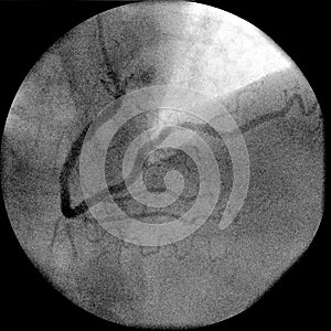 Right coronary artery