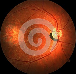 Right eye with familial autosomal dominant drusen photo