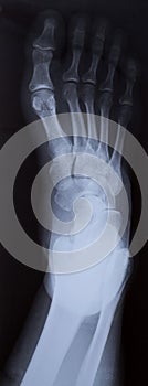 Right foot ankle Xray.