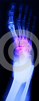 Right foot ankle Xray