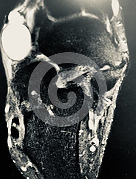 Right foot dorsal aspect mass mri exam