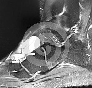 Right foot dorsal aspect mass mri exam