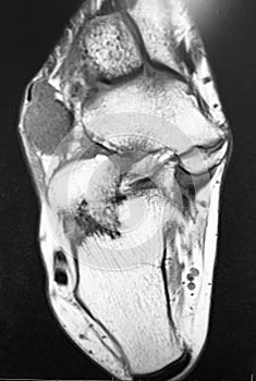 Right foot dorsal aspect mass mri exam