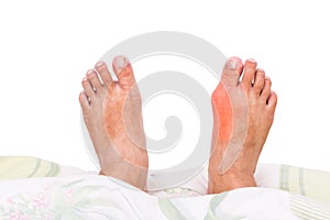 Right foot with painful swollen gout inflammation resting on bed