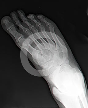 Right foot x-ray#2