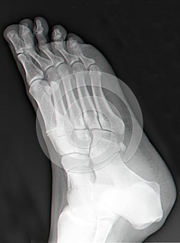 Right foot x-ray