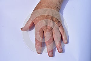 Right hand affected with arthrosis disease on white