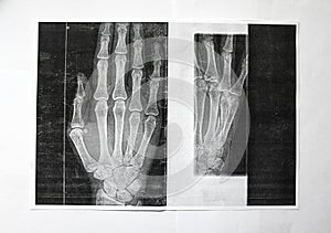 Right hand x ray image