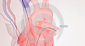 Right heart catheterization involves a catheter that is passed through a vein from the brain to the heart and enters the heart