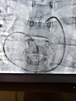 Right heart catheterization photo