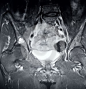 Right hip osteoarthritis pathology mri exam photo