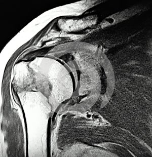 Right humeral surgical neck fracture mri exam