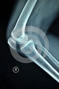 Right knee joint X-ray photograph