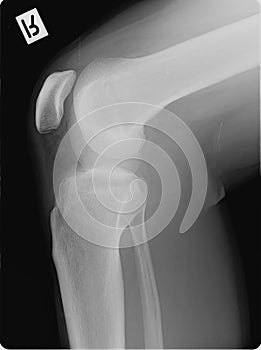 Right knee X-Ray scan