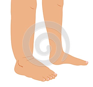 Right leg swollen infection allergy injury in comparison to the normal left leg, illustration on white background