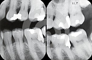 Right Periodontal X-rays