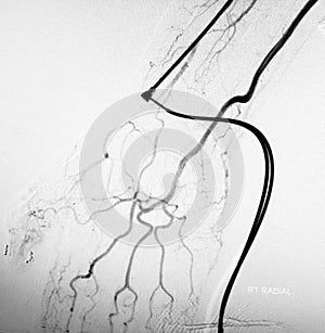 Right radial artery catheterization angiogramm ct