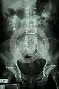 Right renal calculi (staghorn)