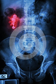 Right renal calculi (staghorn)