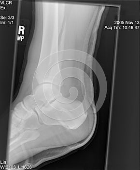 Right Sagittal X-ray photo