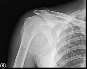 Right shoulder x-ray. Radiograph. Anteroposterior view.